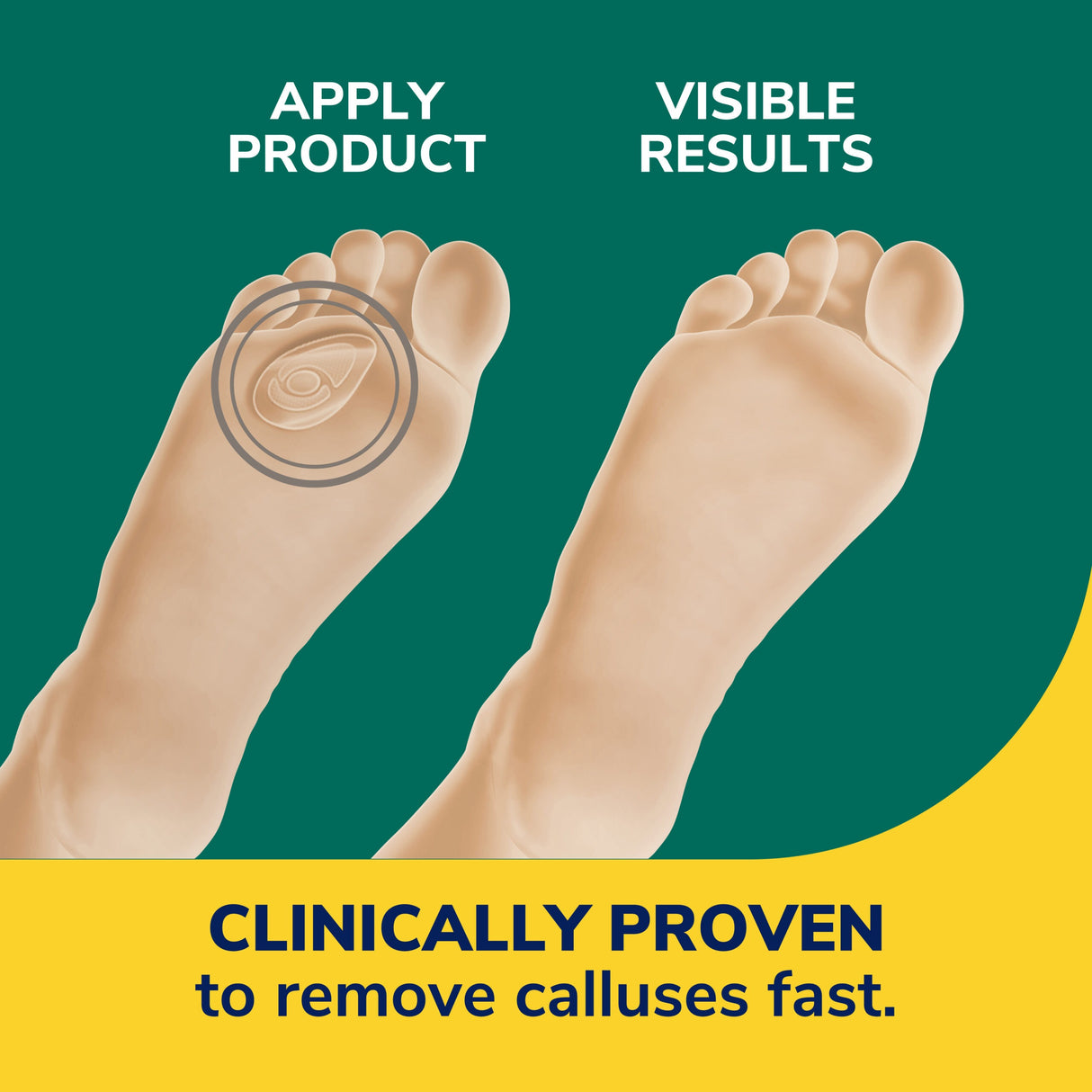 Callus Removers Seal & Heal Bandage with Hydrogel™ Technology