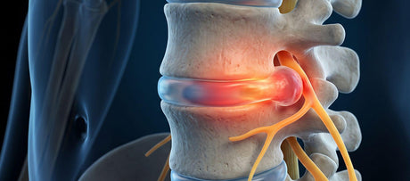 Spine illustration with a red-highlighted disc beside yellow spinal nerves.