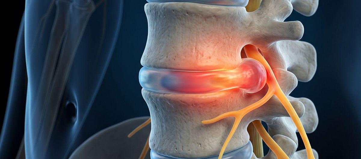 Spine illustration with a red-highlighted disc beside yellow spinal nerves.