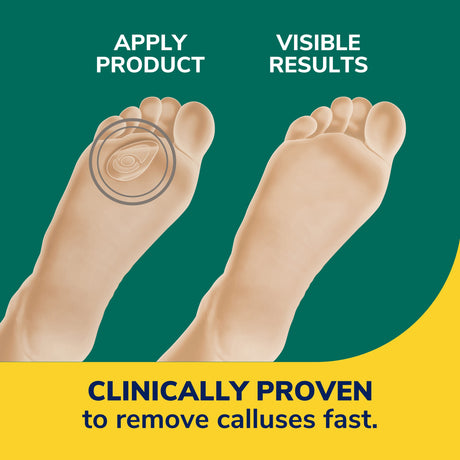 Callus Removers Seal & Heal Bandage with Hydrogel™ Technology