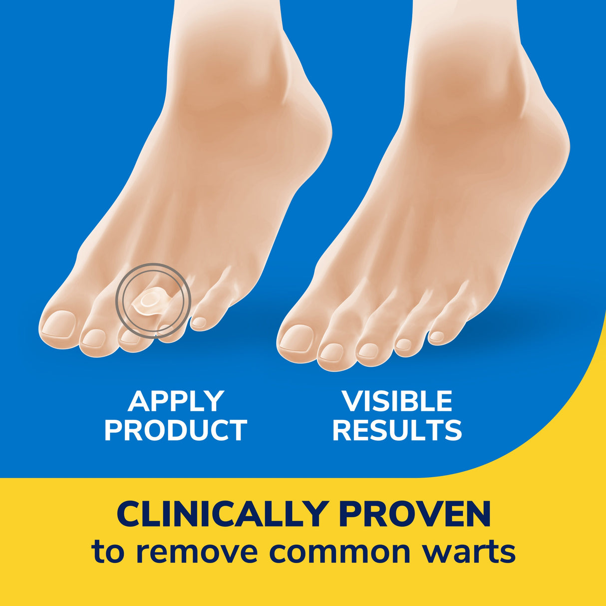 Hydrogel wart remover disc on toes, covering a small circular wart area