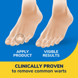Hydrogel wart remover disc on toes, covering a small circular wart area