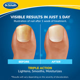 Nail before-and-after illustration for light-activated fungal nail treatment, triple action