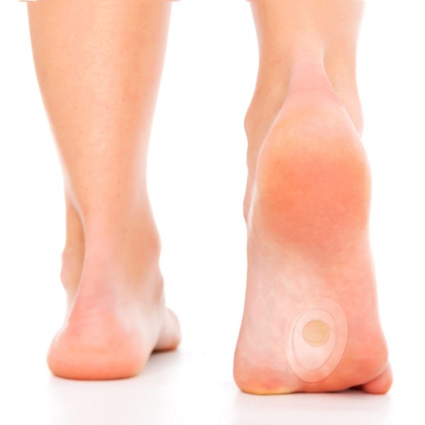 Image of a Person's Foot with a Dr.  Scholl's Callus Remover.