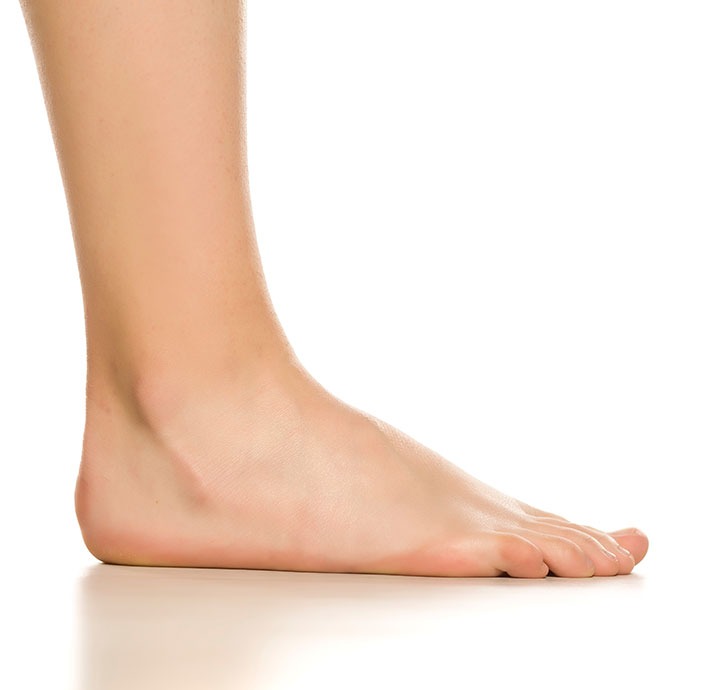 Image of Flat Feet.