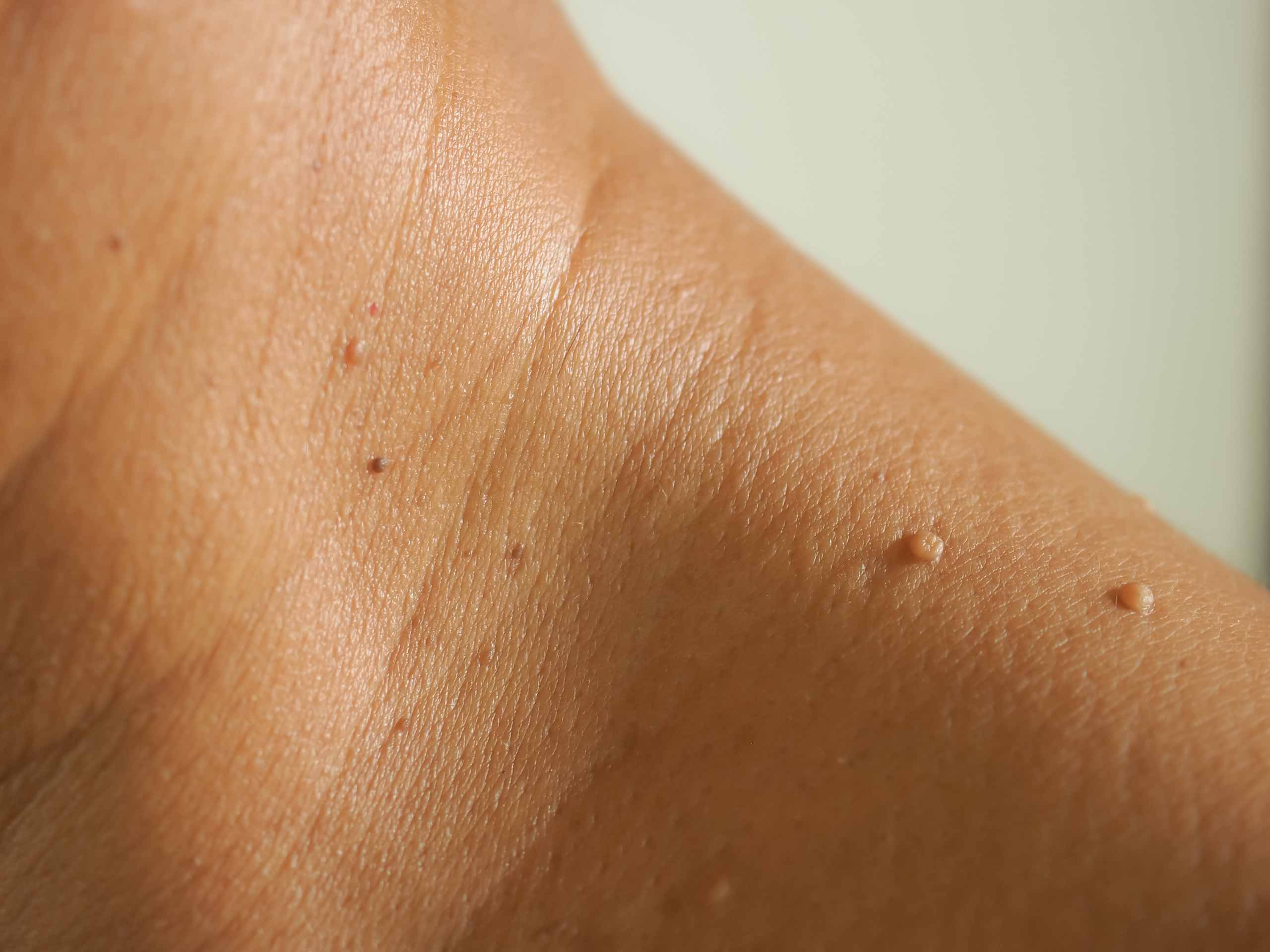 Skin Tag Remover Skin Tags Up Close
