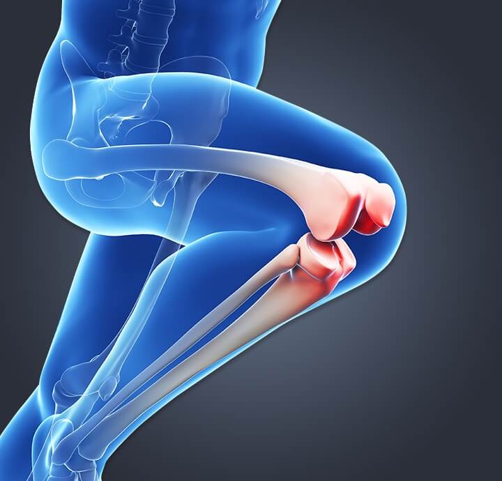Image of a person with runners knee