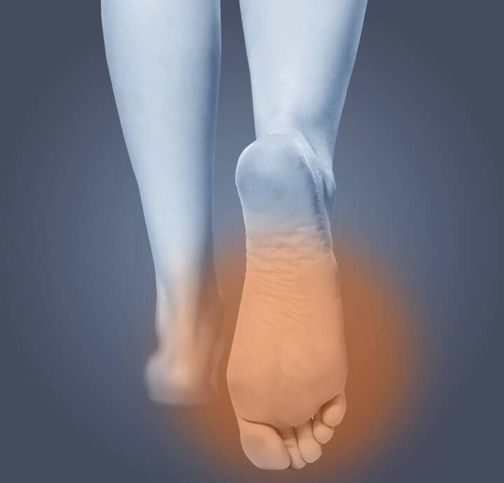 Image of bottom of feet demonstrating  sweaty foot. 