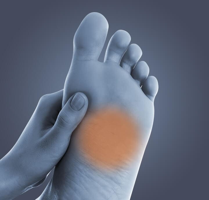 Image of bottom of feet demonstrating  plantar wart. 