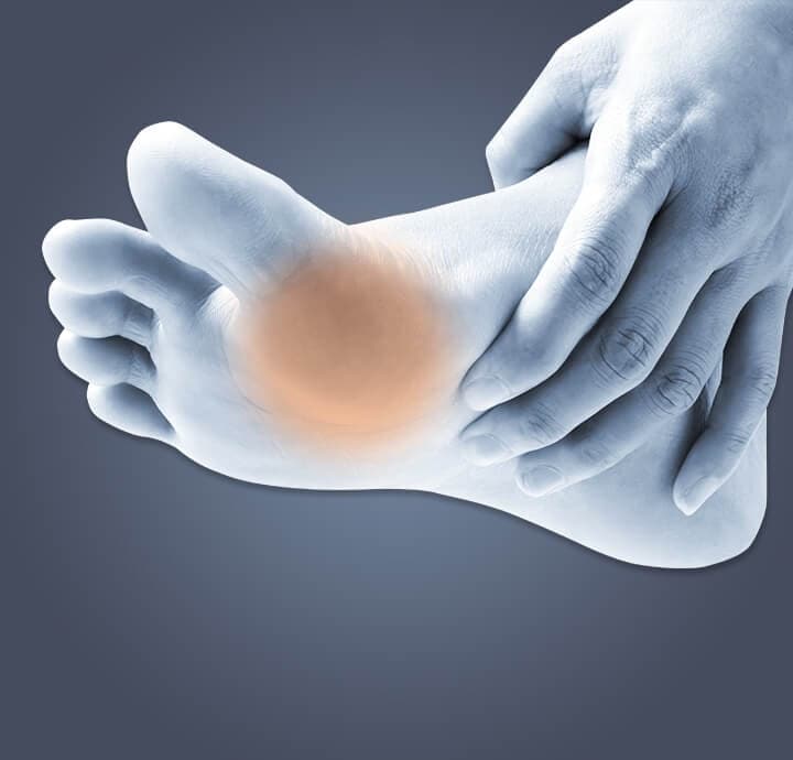 Image of bottom of foot indicating a  callus on foot. 