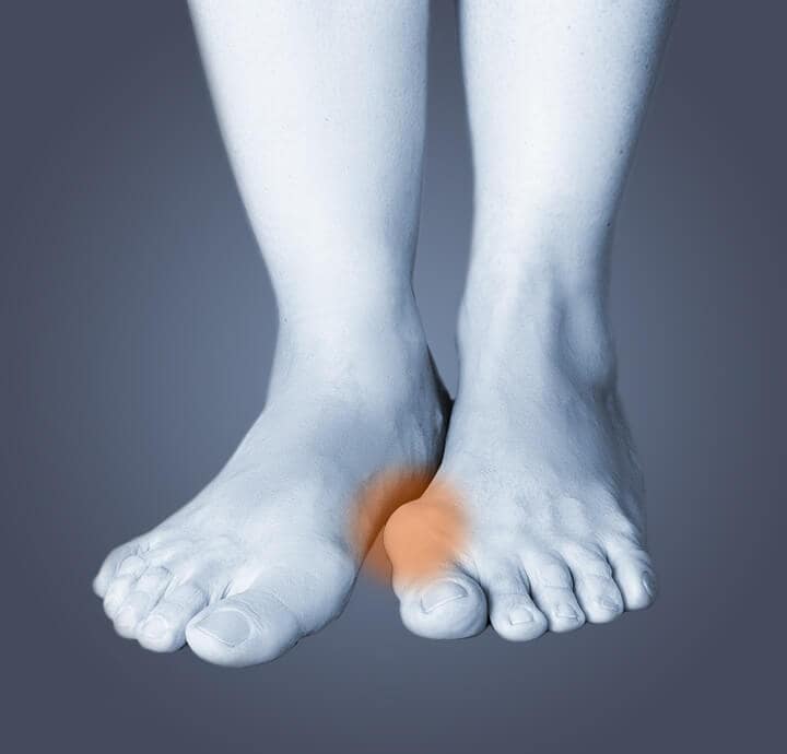 Image of a person's feet with one foot  showing a bunion. 