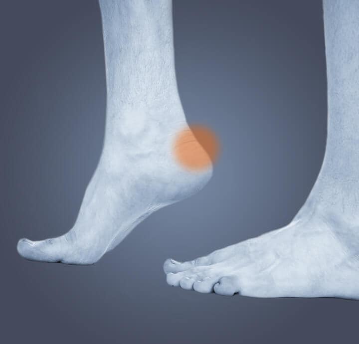 Image of heel foot indicating a blister  on heel. 