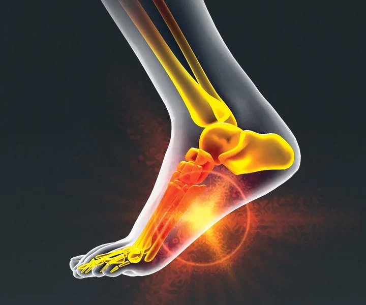 Image of a person with Arch Pain