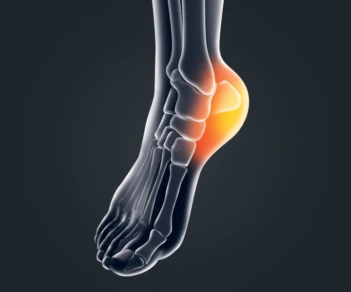 Image of a person with Pain Relief, Heel
