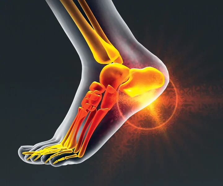Image of a person with Pain Relief,  Plantar Fasciitis