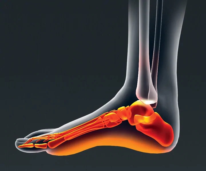 Image of a person with Pain Relief, Sore  Soles
