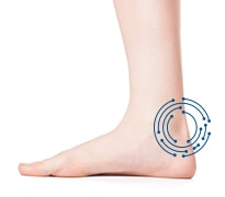 Image of side of foot with area of heel  circled indicating achilles tendinitis.