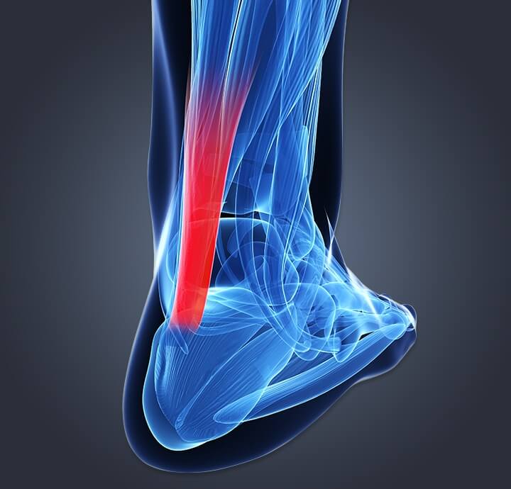 Image of internal  rear of foot to calf showing inflammation from achilles tendinitis.