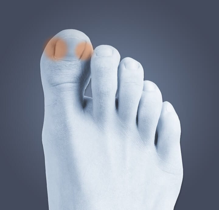 Image of top of foot indicating where  pain occurs from an ingrown toenail. 