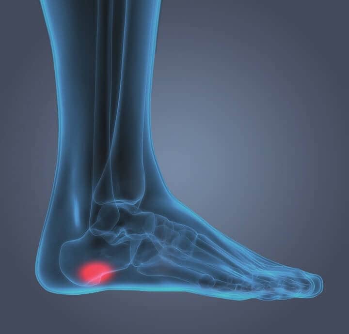 Image of internal foot showing pain from  plantar faciitis in the heel. 