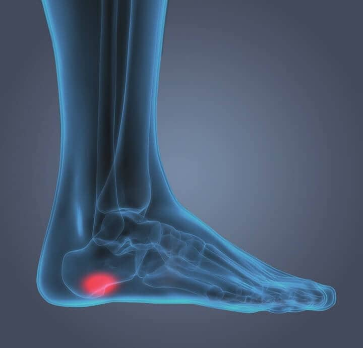 Plantar Fasciitis Symptoms & Pain Relief