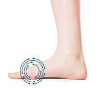 Image of side of foot with bunion  circled. 