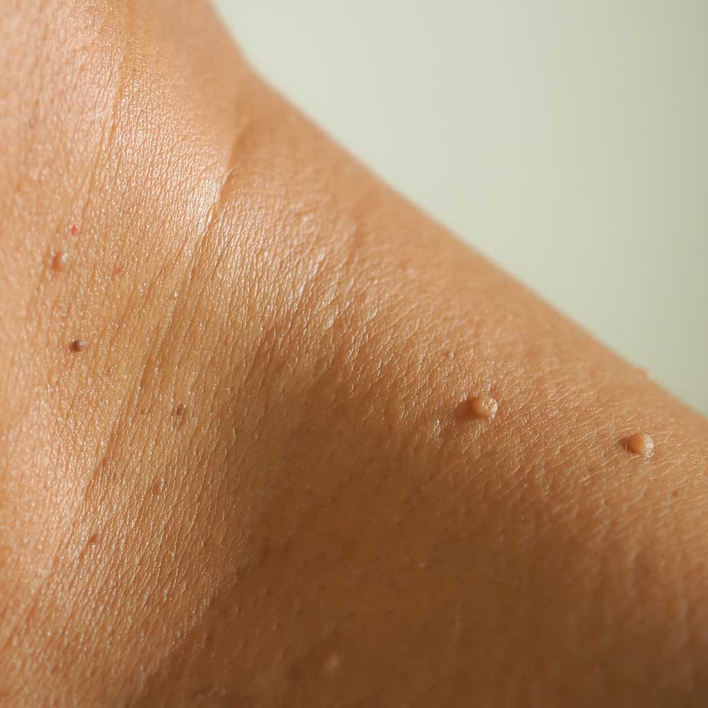 Image of arm showing examples of skin tags.