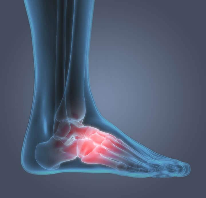 Symptoms & Conditions - Arch of Foot  Pain