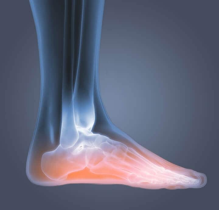 Image radiographique d?un pied illustrant une inflammation due ? des pieds fatigu?s et douloureux.?