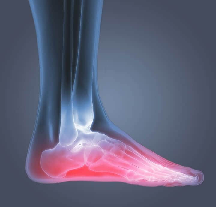 Image radiographique d'un pied illustrant une inflammation due ? l'ost?oarthrite dans les pieds.?