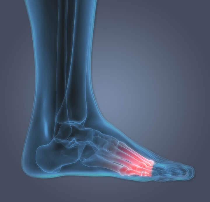 Image radiographique du pied illustrant une douleur ? la pointe du pied.?
