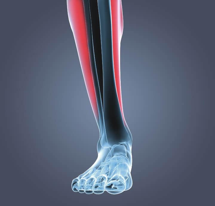 Image d'une personne souffrant du syndrome du stress tibial