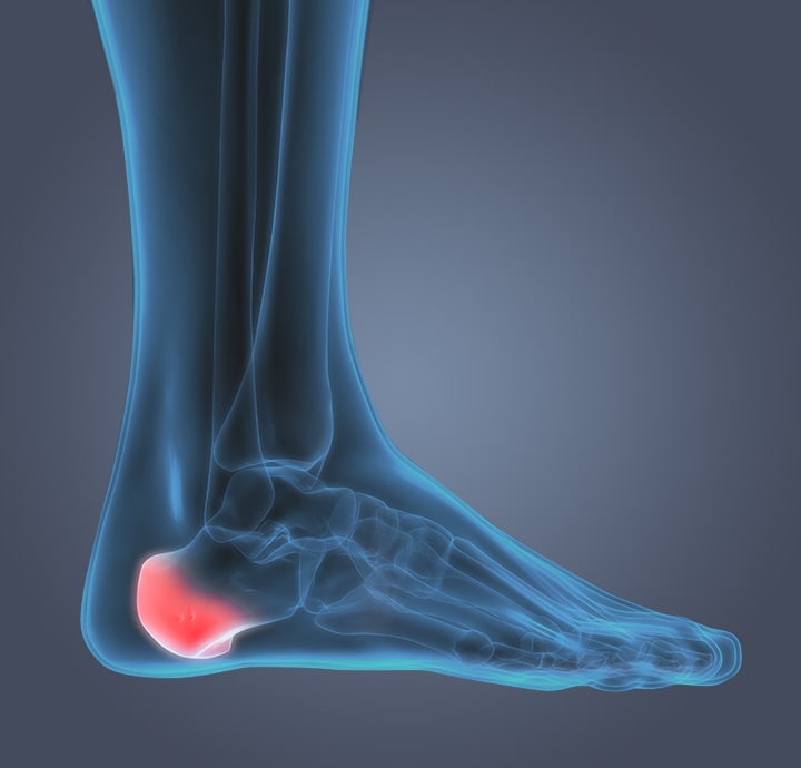 Image de l'anatomie du pied montrant une douleur au niveau du talon ou des ?pines osseuses.?